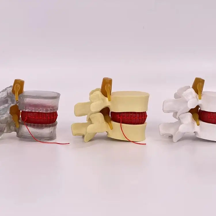 Enlarged human spine and lumbar spine pathology Model demonstration model of lumbar disc herniation Model