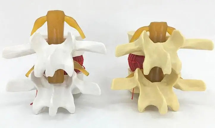 Enlarged human spine and lumbar spine pathology Model demonstration model of lumbar disc herniation Model