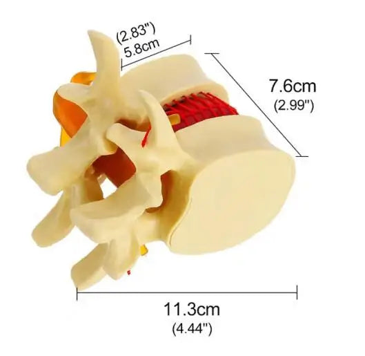 Enlarged human spine and lumbar spine pathology Model demonstration model of lumbar disc herniation Model