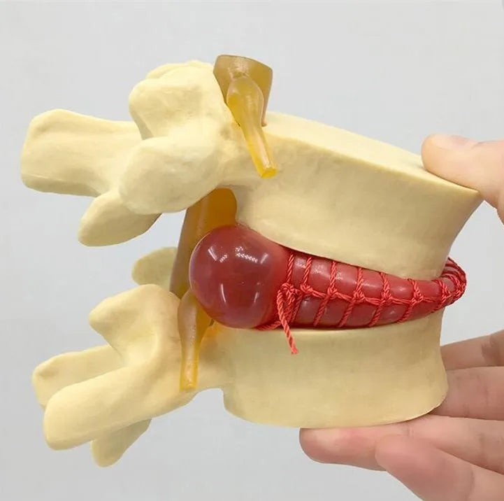 Enlarged human spine and lumbar spine pathology Model demonstration model of lumbar disc herniation Model