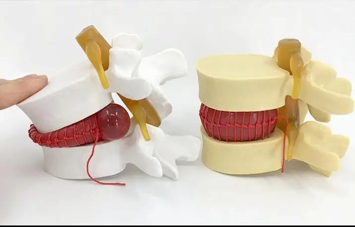 Enlarged human spine and lumbar spine pathology Model demonstration model of lumbar disc herniation Model