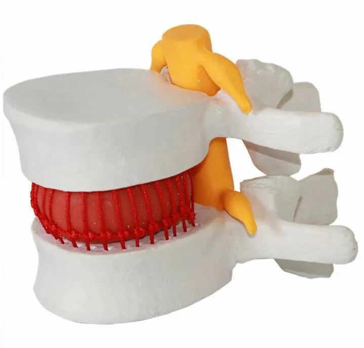Enlarged human spine and lumbar spine pathology Model demonstration model of lumbar disc herniation Model