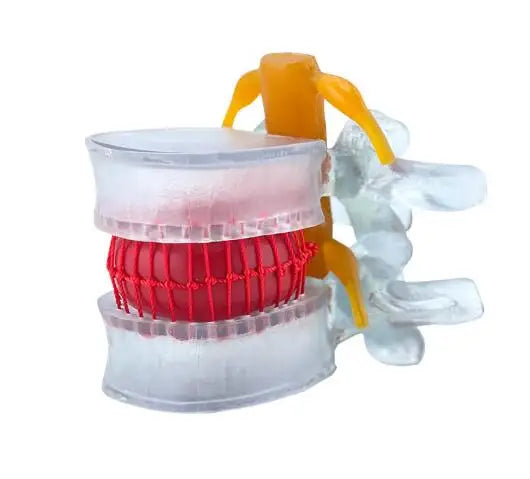Enlarged human spine and lumbar spine pathology Model demonstration model of lumbar disc herniation Model