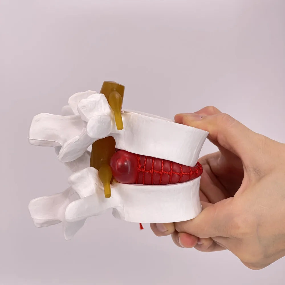 Enlarged human spine and lumbar spine pathology Model demonstration model of lumbar disc herniation Model