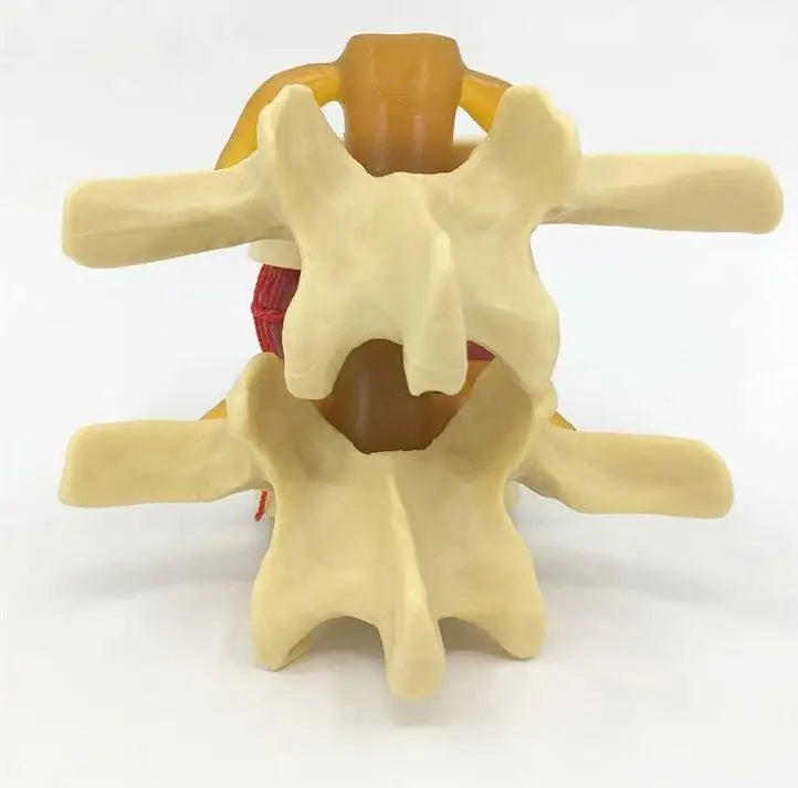 Enlarged human spine and lumbar spine pathology Model demonstration model of lumbar disc herniation Model