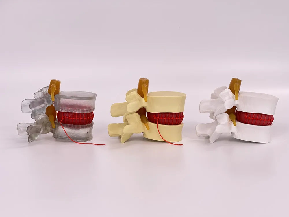 Enlarged human spine and lumbar spine pathology Model demonstration model of lumbar disc herniation Model